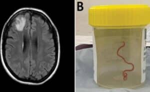 cerebro