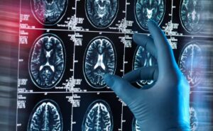 cerebro