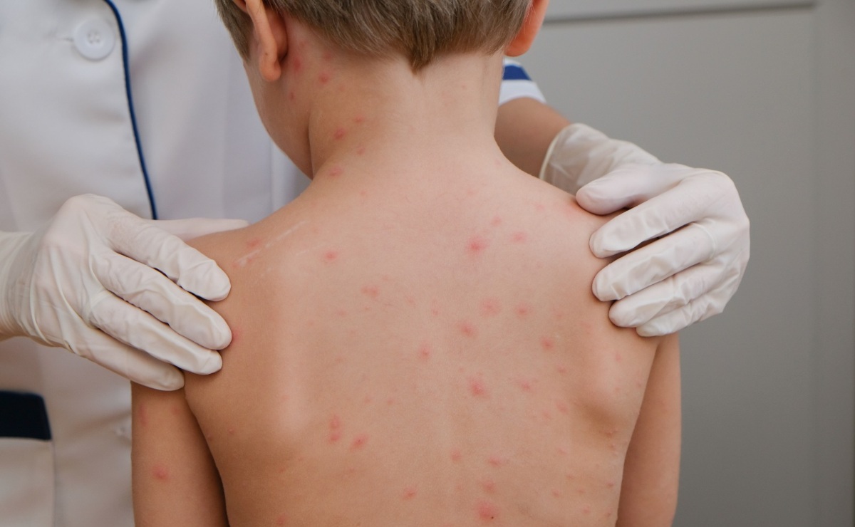 estos-son-los-puntos-de-vacunacion-contra-el-sarampion-2