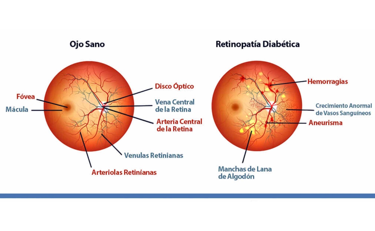 unam-desarrolla-gotas-contra-la-ceguera-por-diabetes